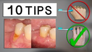 10 Tips to Minimize Gum Recession at Home [upl. by Polinski]