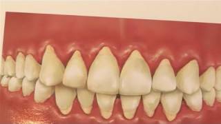 How To Treat Receding Gums [upl. by Amanda]