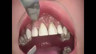 Gum Graft Dental Surgery [upl. by Ahsiakal]