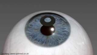 Presbyopia Vision Simulation [upl. by Etteloiv466]