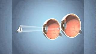 What Is Presbyopia [upl. by Ansela]