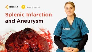 Splenic Infarction and Aneurysm  General Surgery Lectures  Student Education  VLearning [upl. by Nebe]