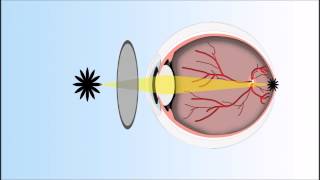 Multifocal VS Monovision Contacts  Contacts For Presbyopia [upl. by Killian503]