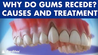 Gum recession  Treatment of gingival retraction © [upl. by Mackie]