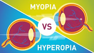 Eye defects  Hyperopia Astigmatism Presbyopia  Dont Memorise [upl. by Olegnaleahcim]