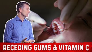 Receding Gums and Vitamin C Explained By DrBerg [upl. by Nilecoj247]