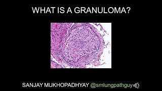 Understanding Sarcoidosis A Visual Guide for Students [upl. by Ailliw252]