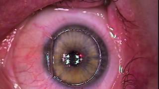 Difference between Myopia Near Sightedness amp Hyperopia FarSightedness [upl. by Dnalor]