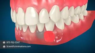 Gum Grafting Surgery  Dental Animation [upl. by Lawry]